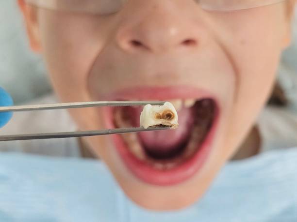 Best Emergency Root Canal Treatment in Barrett, TX